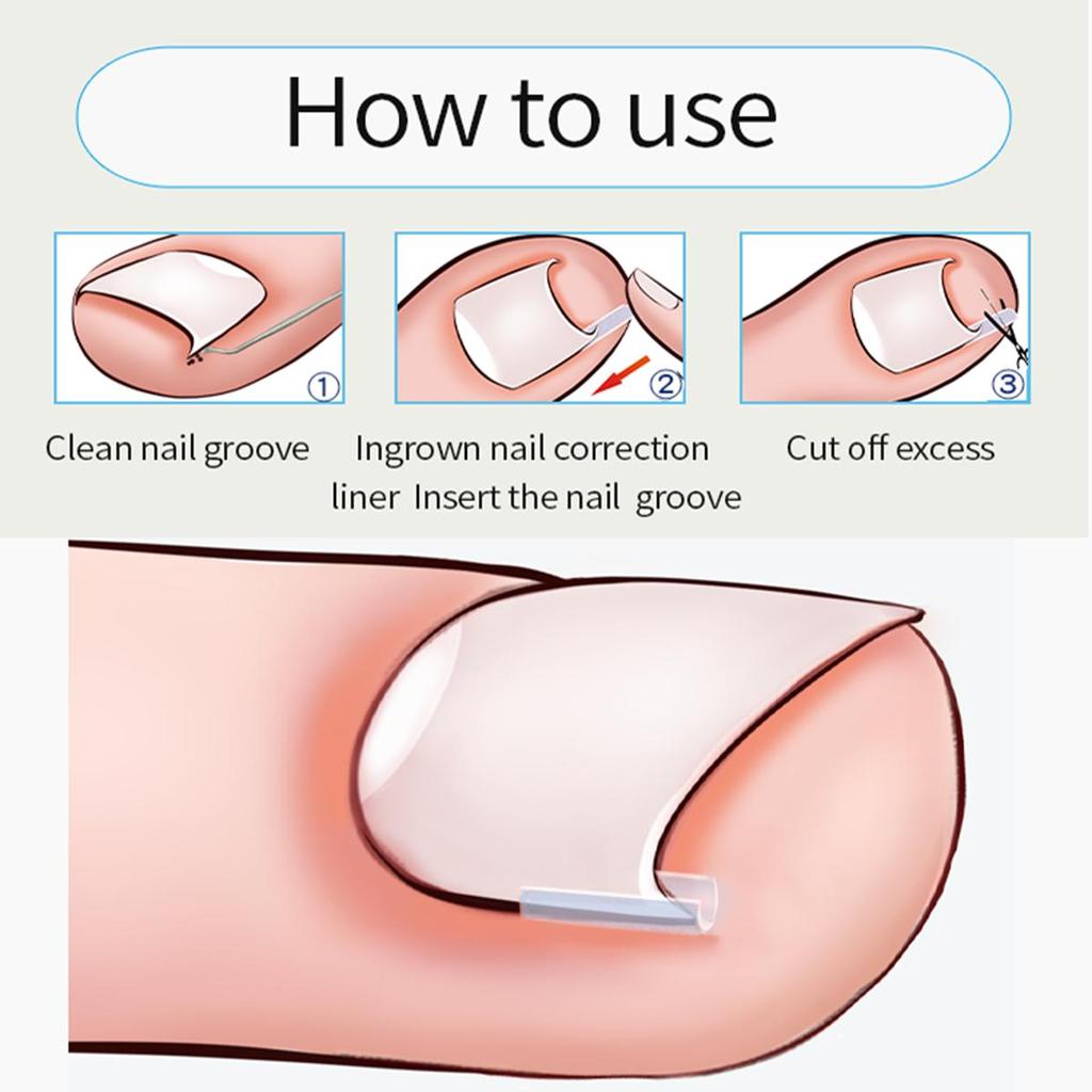 Ingrown Toenail Correction Elastic Patch Set, 10pcs by HitMyNeed