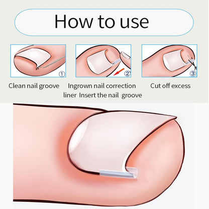 Ingrown Toenail Correction Elastic Patch Set, 10pcs by HitMyNeed
