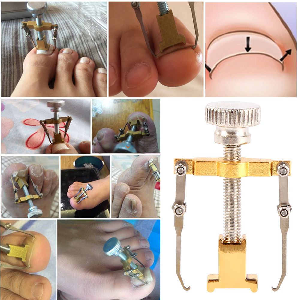 Ingrown Toenail Corrector and Lifter Tool by HitMyNeed