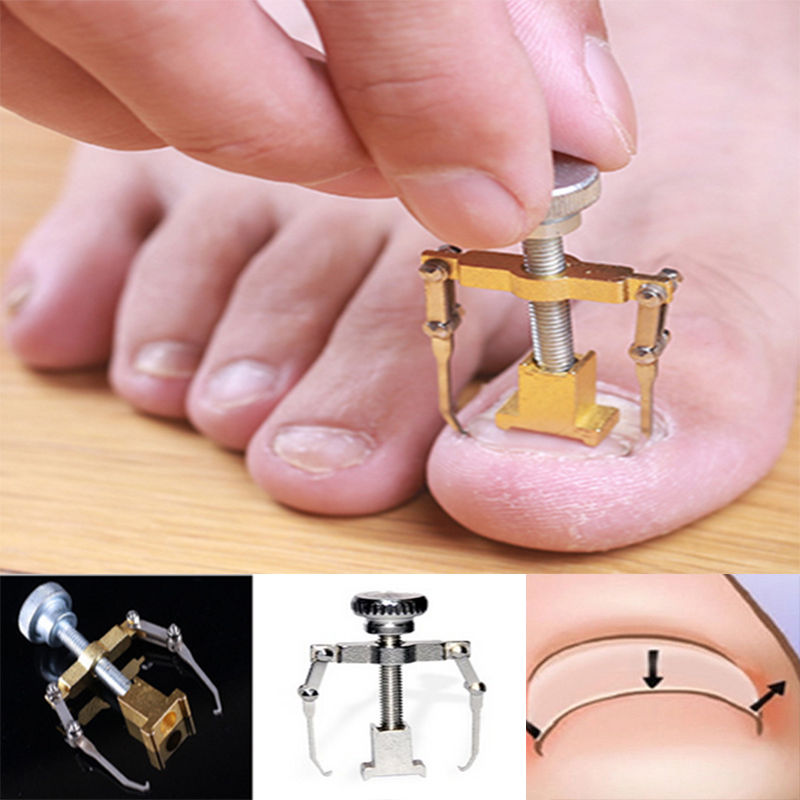 Ingrown Toenail Corrector and Lifter Tool by HitMyNeed