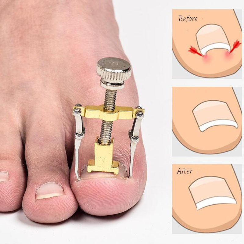 Ingrown Toenail Corrector Pedicure Tool by HitMyNeed