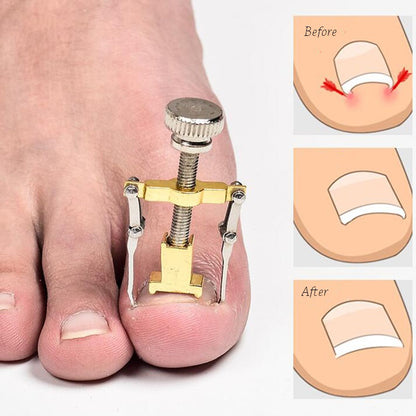 Ingrown Toenail Corrector Pedicure Tool by HitMyNeed