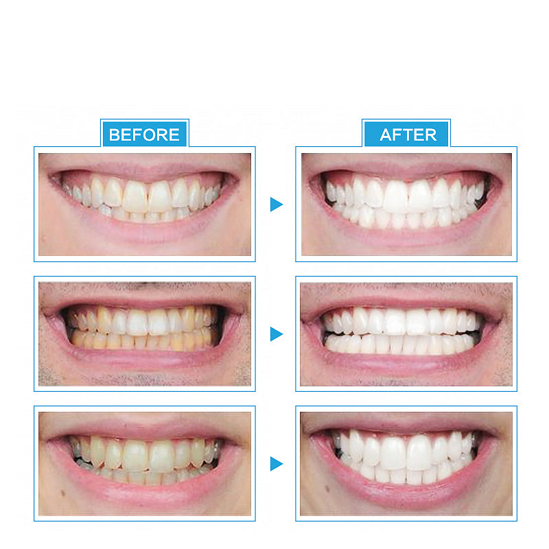 Instant LED Light Teeth Whitening Kit by HitMyNeed