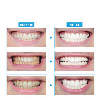 Instant LED Light Teeth Whitening Kit by HitMyNeed