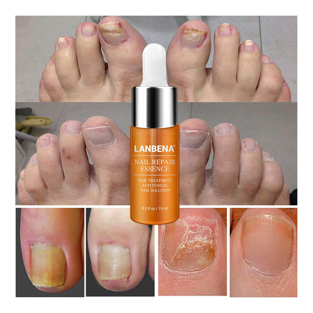 Labrena Nail Fungus Treatment Serum 12ml by HitMyNeed