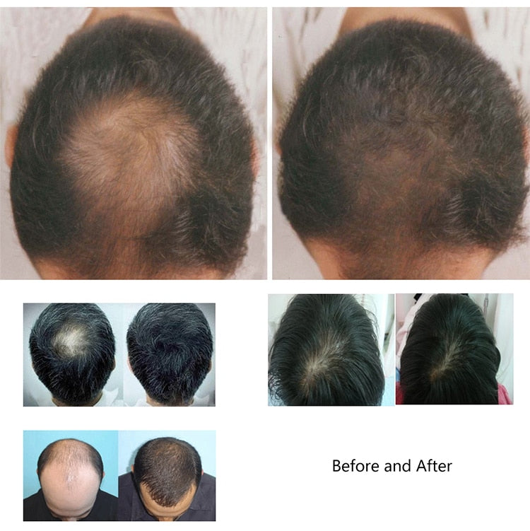 Laser Hair Growth Helmet for Hair Loss Treatment by HitMyNeed