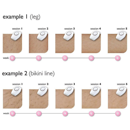 Laser Hair Removal Pro Epilator Device by HitMyNeed