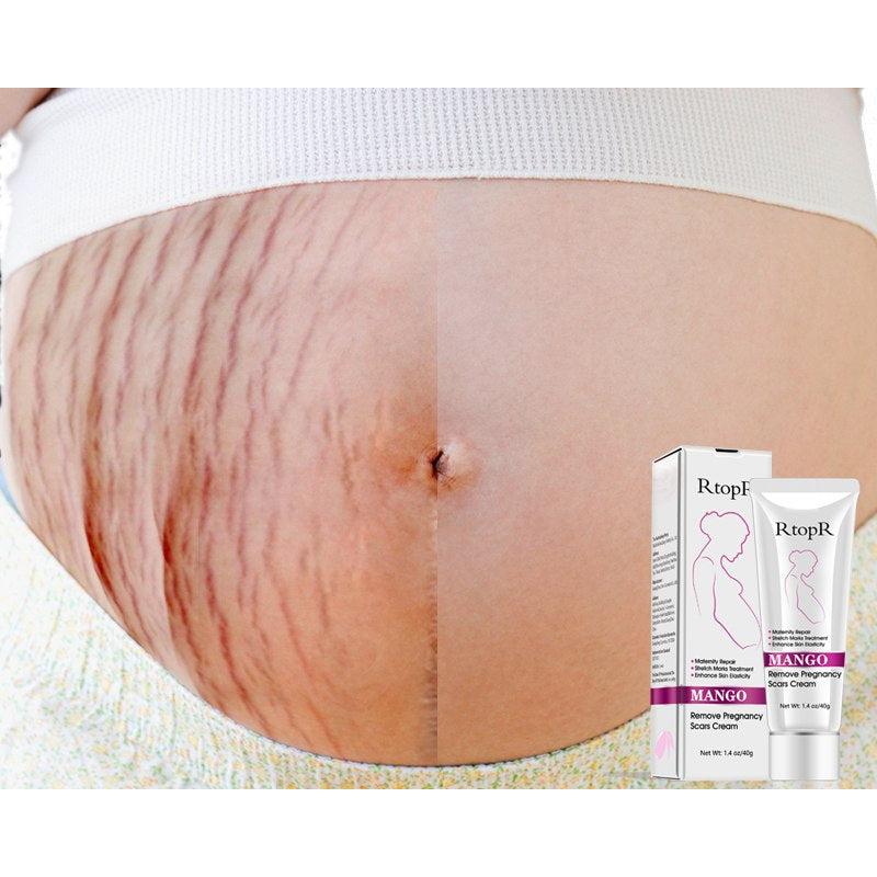 Mango Stretch Mark Cream for Pregnancy 40g by HitMyNeed