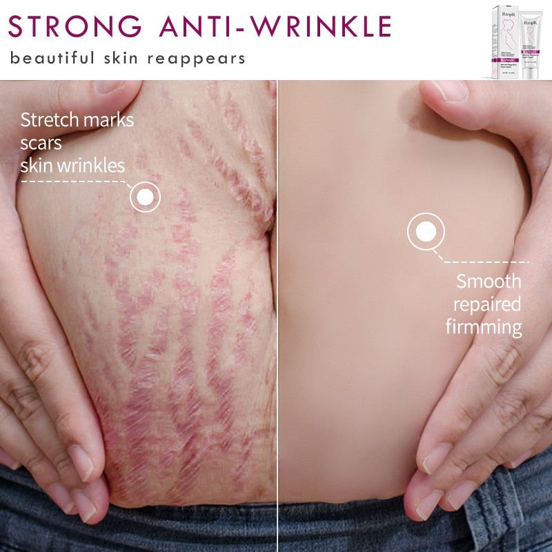 Mango Stretch Mark Cream for Pregnancy 40g by HitMyNeed