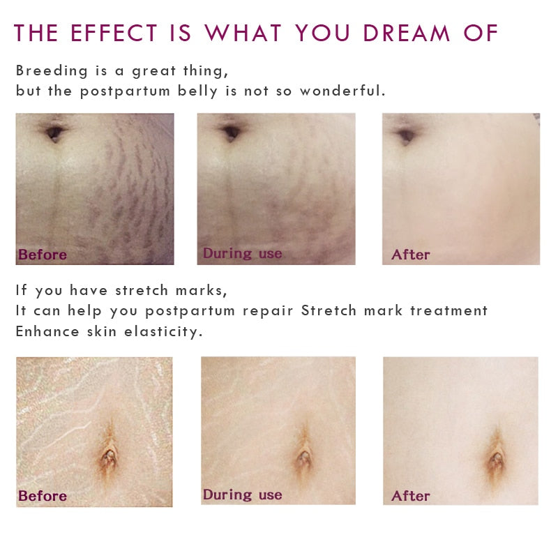 Mango Stretch Mark Cream for Pregnancy 40g by HitMyNeed