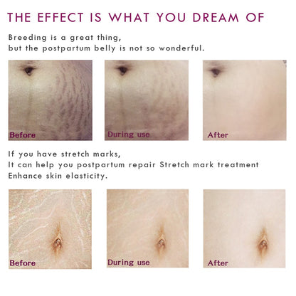 Mango Stretch Mark Cream for Pregnancy 40g by HitMyNeed