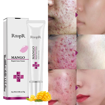 Mango Whitening Cream Acne & Scar Treatment 15g by HitMyNeed