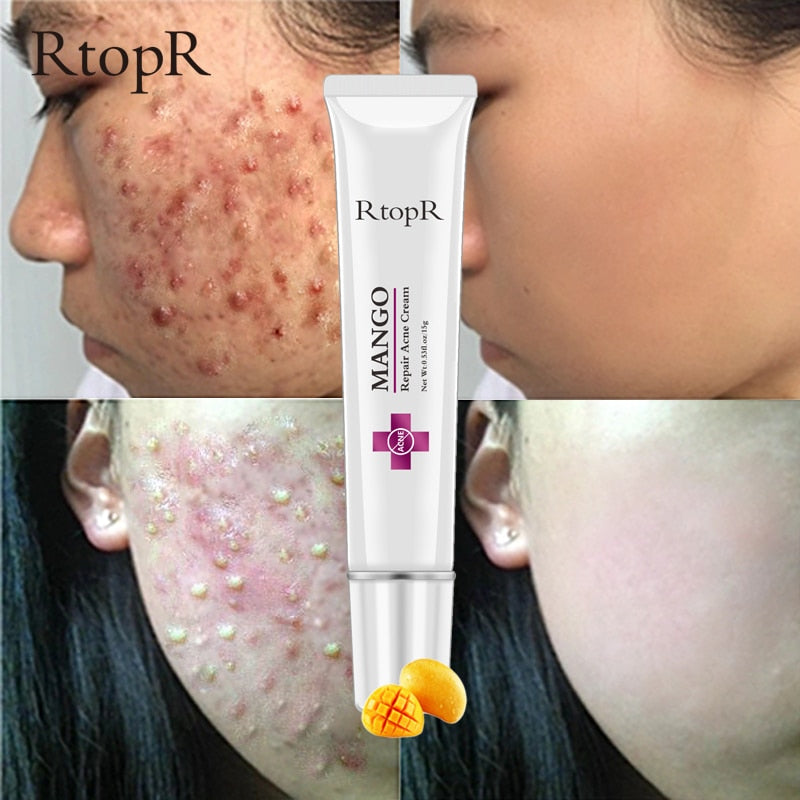 Mango Whitening Cream Acne & Scar Treatment 15g by HitMyNeed