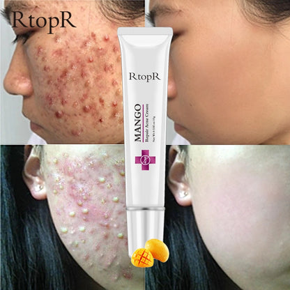 Mango Whitening Cream Acne & Scar Treatment 15g by HitMyNeed