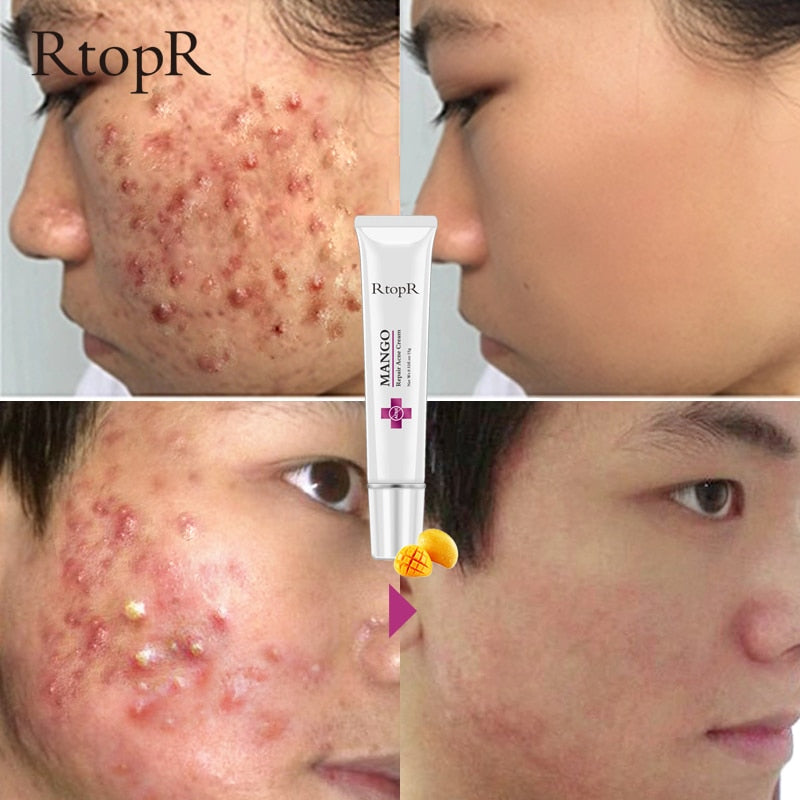 Mango Whitening Cream Acne & Scar Treatment 15g by HitMyNeed