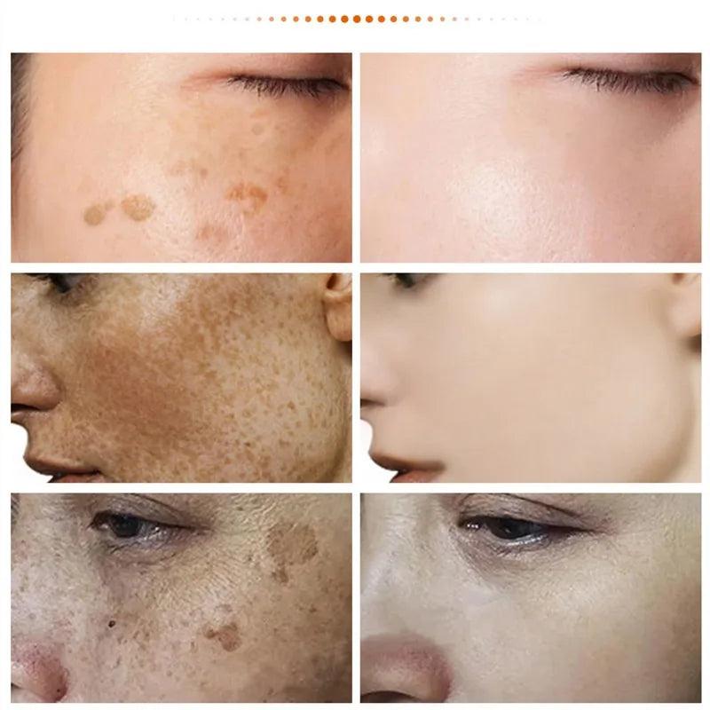 Melasma & Dark Spot Correcting Face Cream by HitMyNeed