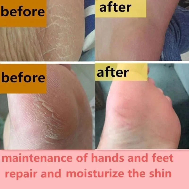 Moisturizing Anti-Crack Foot & Hand Cream 30g by HitMyNeed