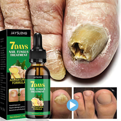 Nail Fungus Treatment Essence Oil 20ml by HitMyNeed