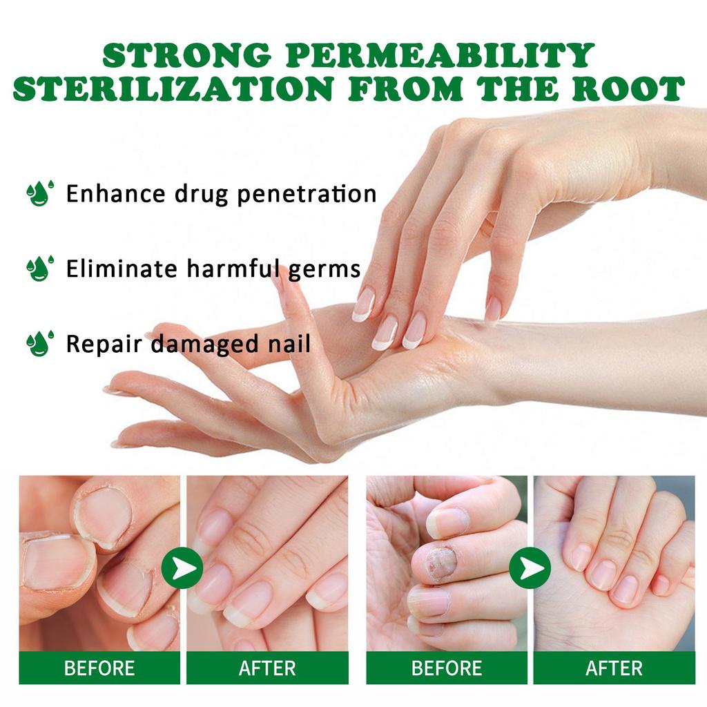 Nail Fungus Treatment Essence Oil 20ml by HitMyNeed