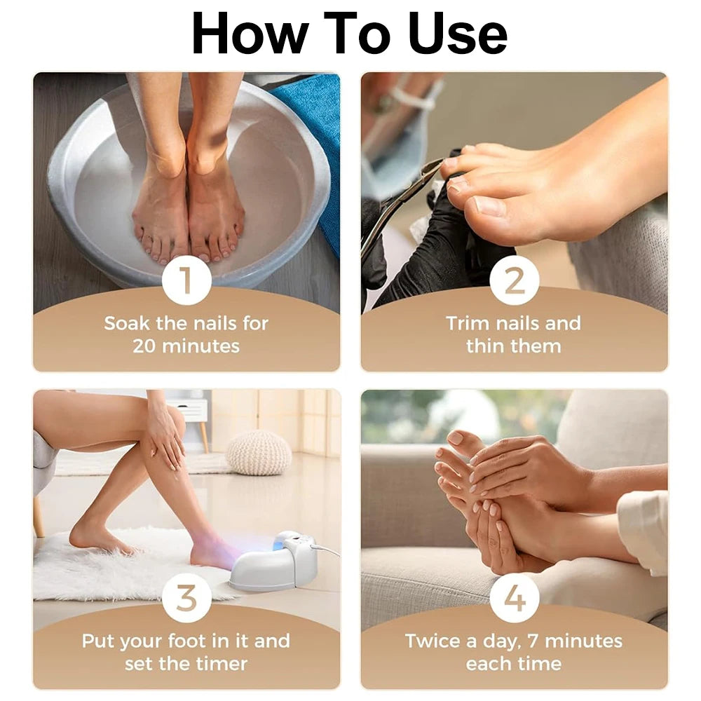 Nail Laser Fungus Device for Hands and Feet by HitMyNeed