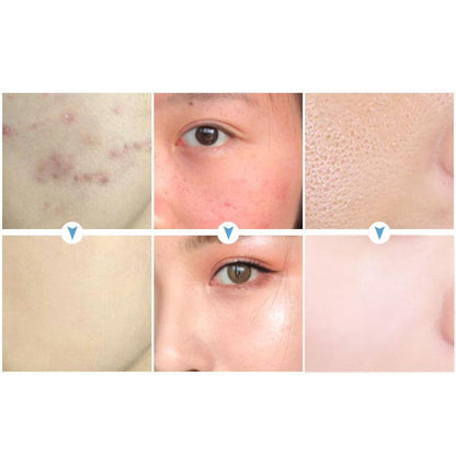 Organic Tea Tree Acne Spot & Dark Spot Cream 15g by HitMyNeed