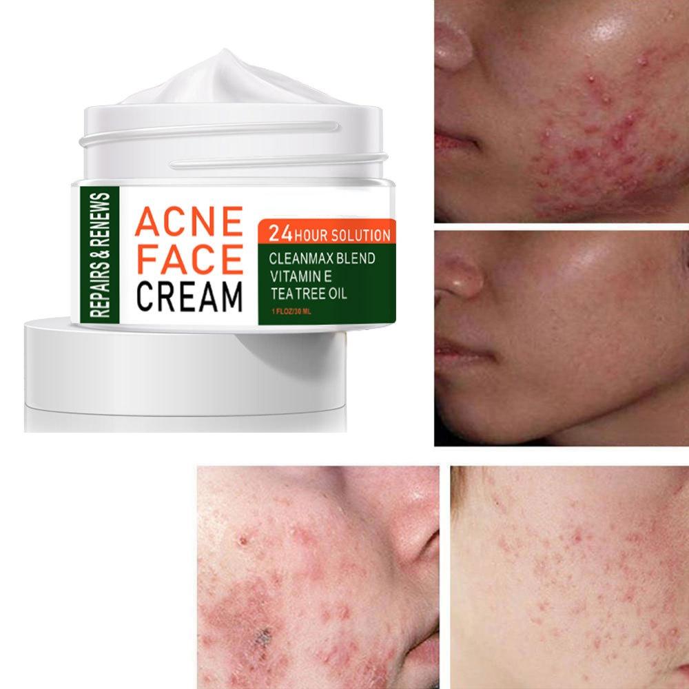 Organic Tea Tree Acne Spot & Dark Spot Cream by HitMyNeed