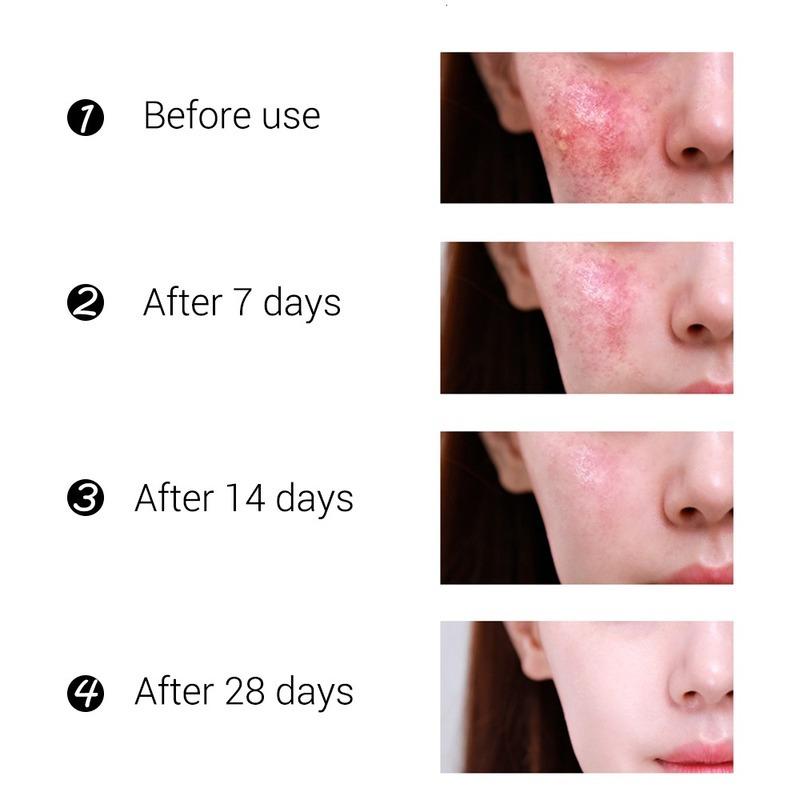 Organic Tea Tree Acne Spot & Dark Spot Cream 50g by HitMyNeed