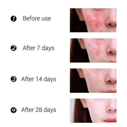 Organic Tea Tree Acne Spot & Dark Spot Cream 50g by HitMyNeed