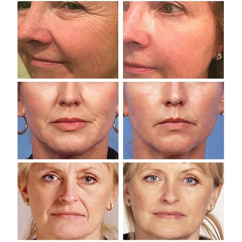 Pure Retinol 0.5% Face Serum with Squalane 30ml by HitMyNeed