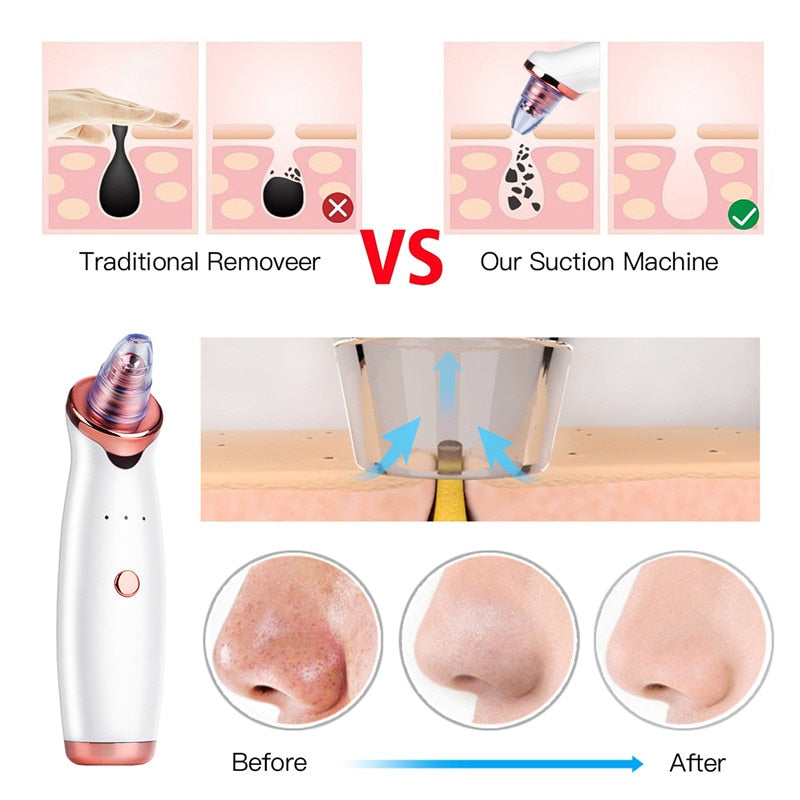 Rechargeable Blackhead Vacuum Pore Cleaner by HitMyNeed