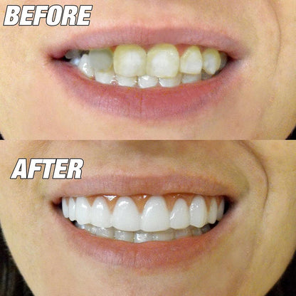Reusable Front Veneer Teeth With Comfort Fit by HitMyNeed