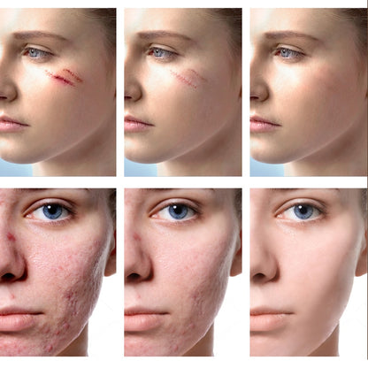 Scar & Acne Mark Treatment Gel with Aloe & Centella by HitMyNeed