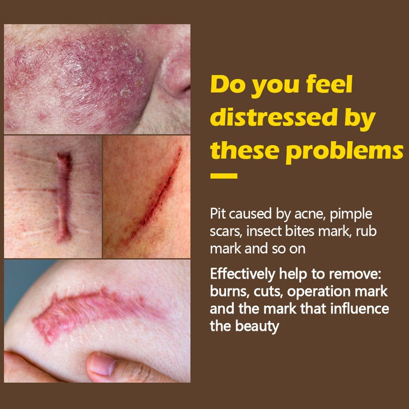 Scar & Acne Mark Treatment Gel with Aloe & Centella by HitMyNeed