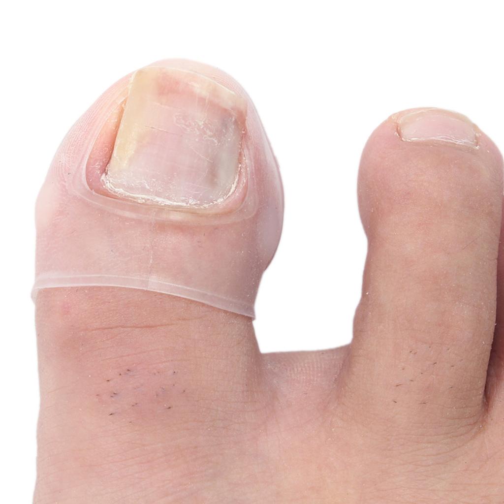 Silicone Ingrown Toenail Correction Sleeves (2pcs) by HitMyNeed