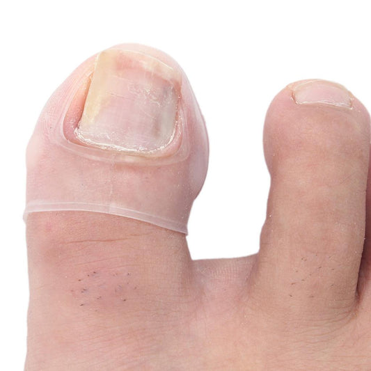 Silicone Ingrown Toenail Correction Sleeves (2pcs) by HitMyNeed