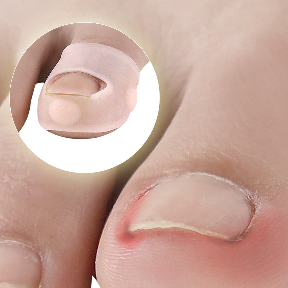 Silicone Ingrown Toenail Correction Sleeves (2pcs) by HitMyNeed
