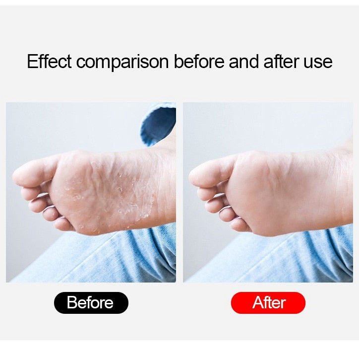 Steel Callus File Dead Skin Remover for Feet by HitMyNeed