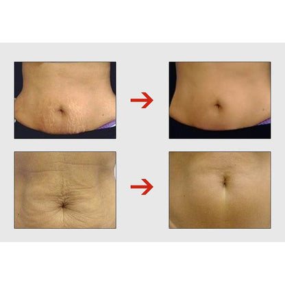 Stretch Mark Reduction Cream with Centella Extract 50g by HitMyNeed