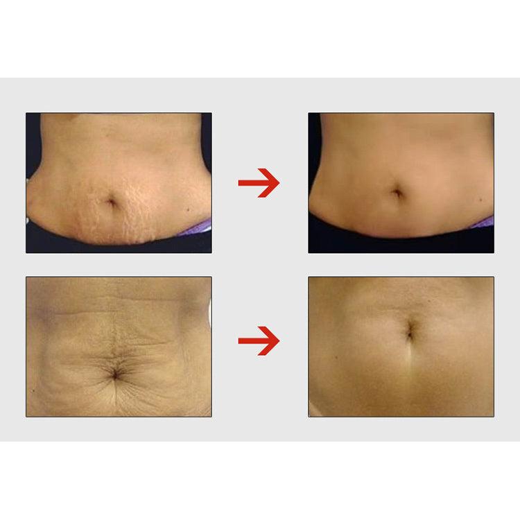 Stretch Mark Reduction Cream with Centella Extract 50g by HitMyNeed
