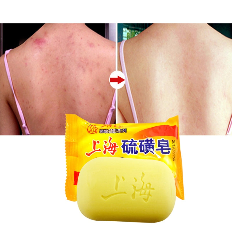 Sulfur Soap Acne Cleanser Bar 90g by HitMyNeed