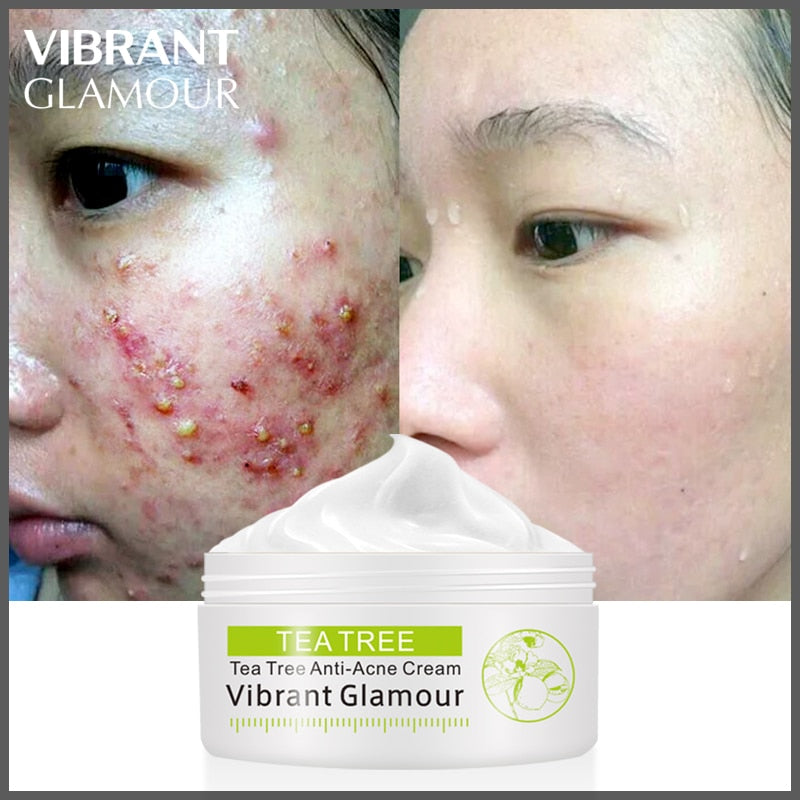 Tea Tree Acne Cream for Clearer Facial Skin 20g by HitMyNeed