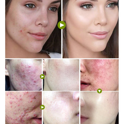 Tea Tree Acne Cream for Clearer Facial Skin 20g by HitMyNeed