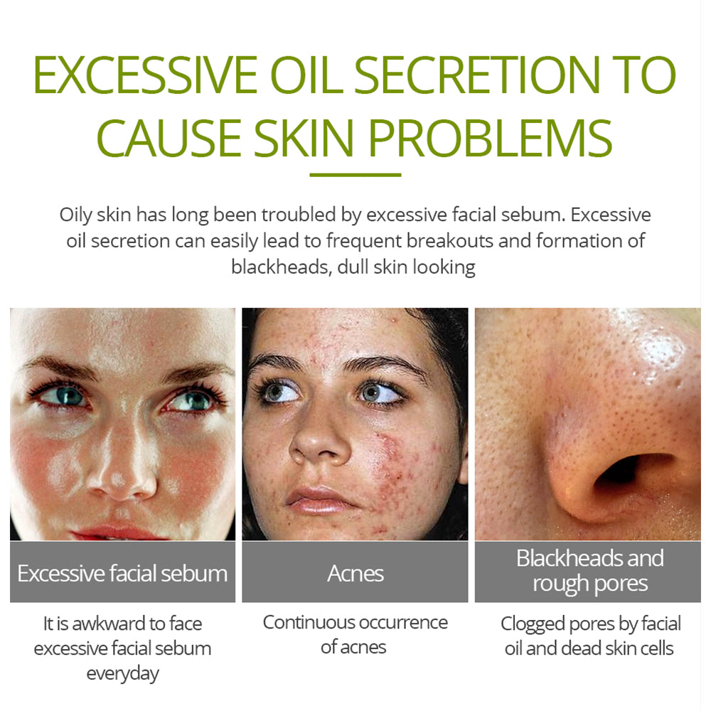 Tea Tree Acne Cream for Clearer Facial Skin 20g by HitMyNeed