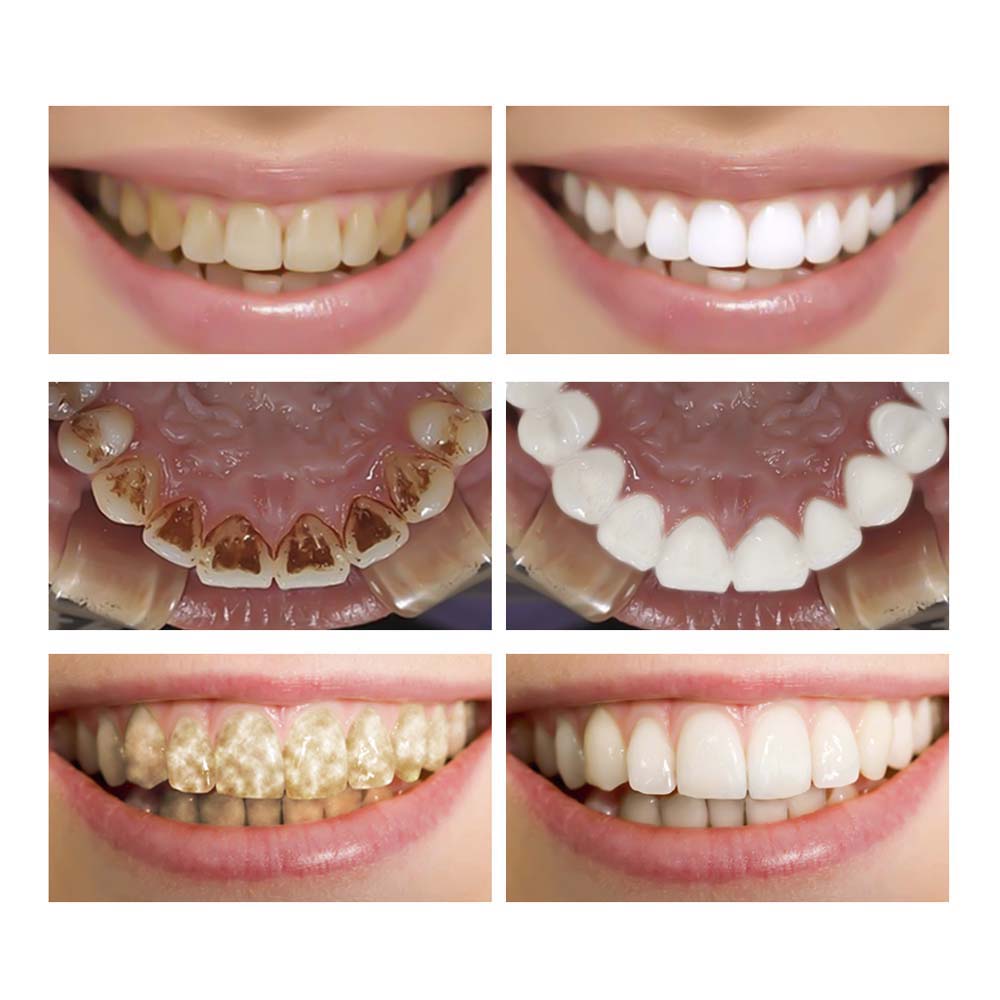 Teeth Whitening & Cleaning Serum by HitMyNeed