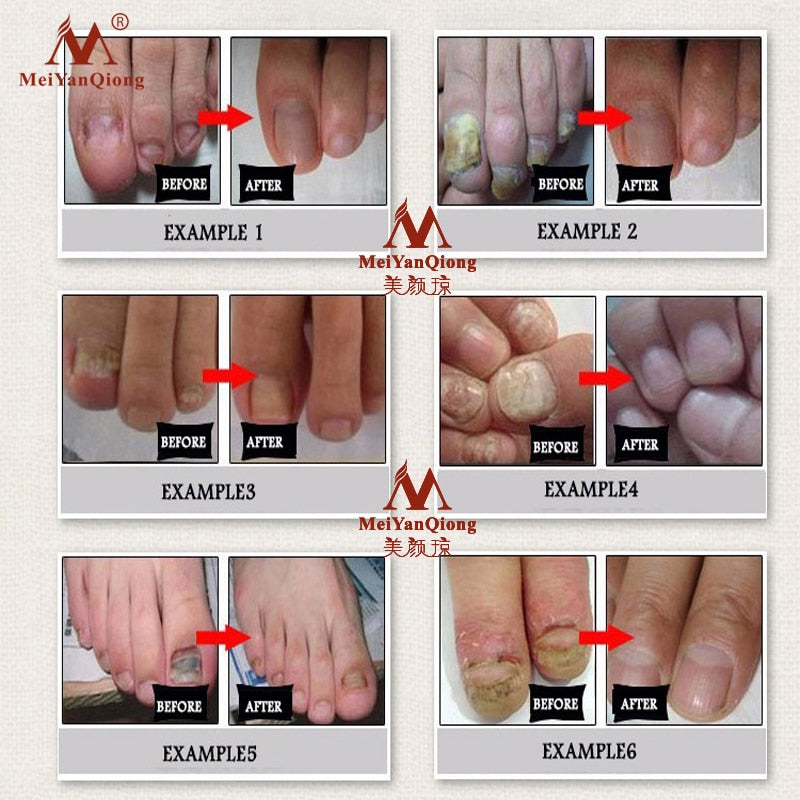 Topical Antifungal Nail Care Oil 30ml by HitMyNeed