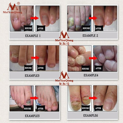 Topical Antifungal Nail Care Oil 30ml by HitMyNeed