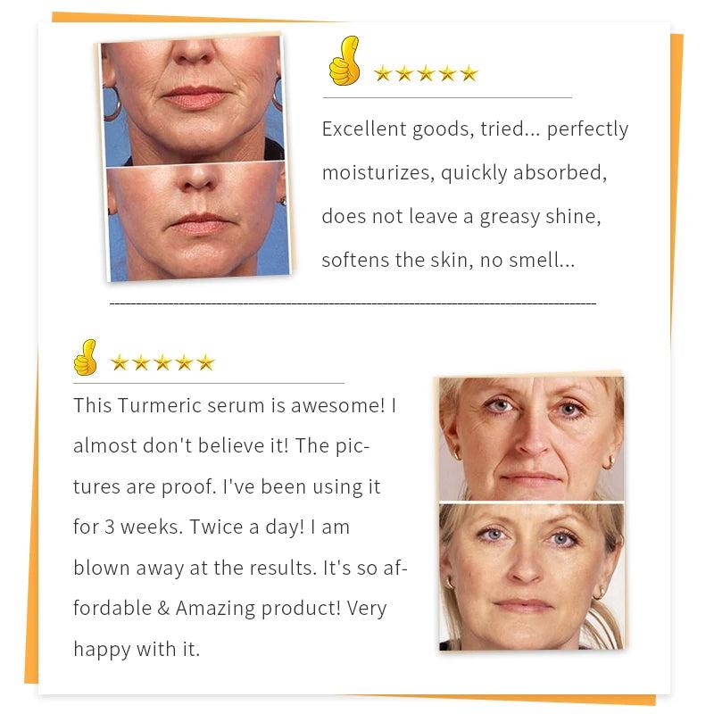 Turmeric Brightening Serum for Dark Spots & Acne by HitMyNeed