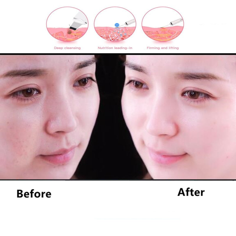Ultrasonic Facial Skin Scrubber with 3 Care Modes by HitMyNeed