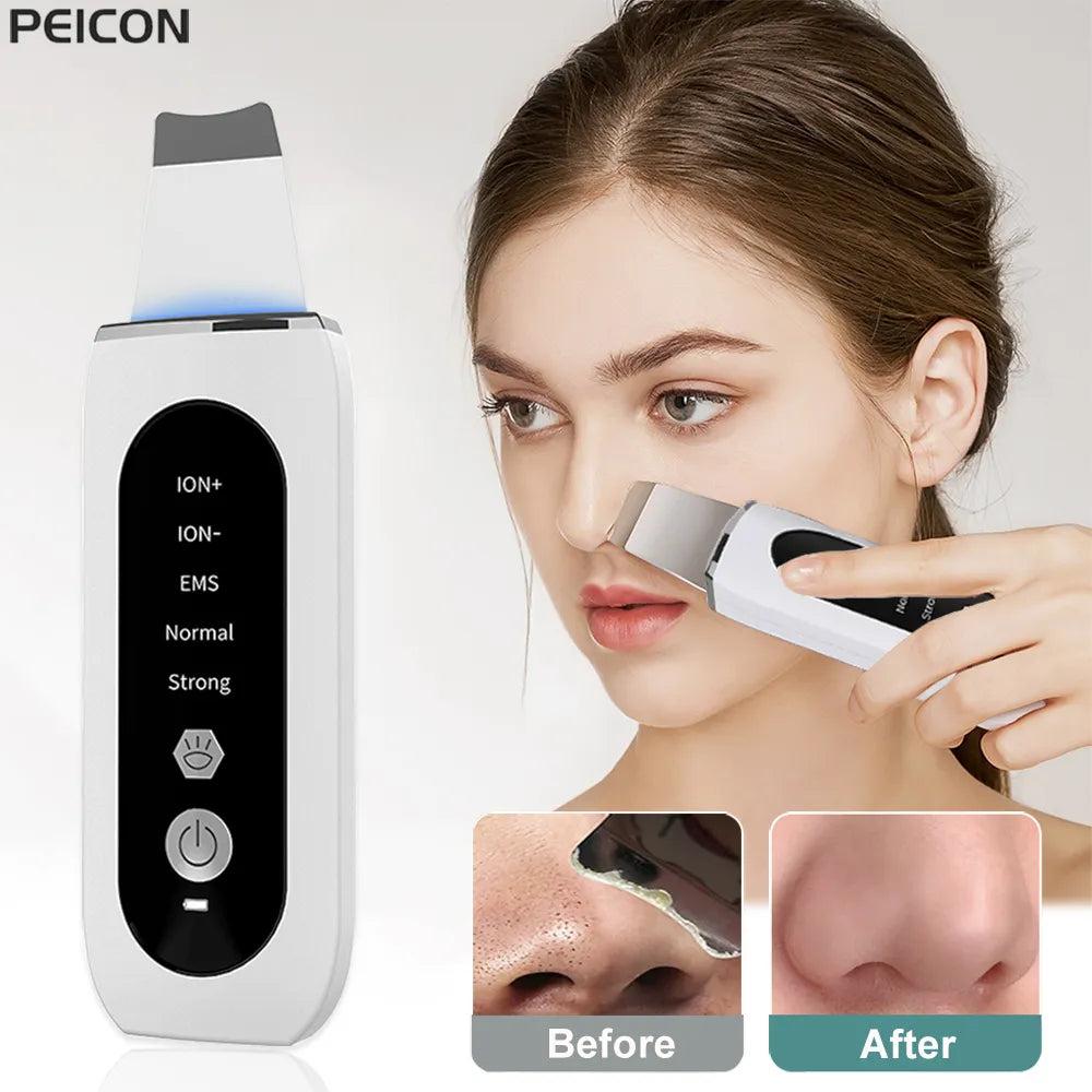 Ultrasonic Skin Scrubber Blackhead & Pore Cleaner by HitMyNeed
