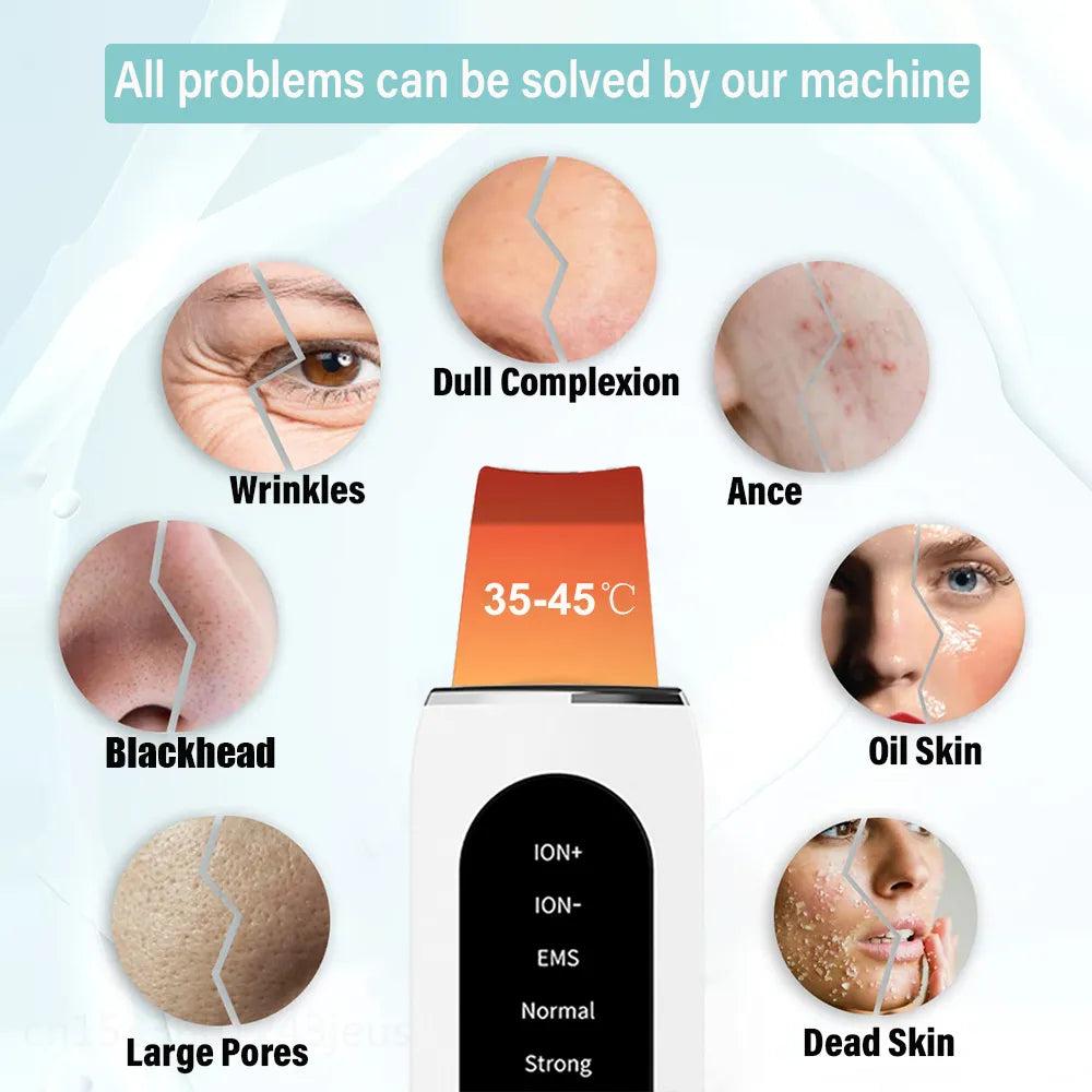 Ultrasonic Skin Scrubber Blackhead & Pore Cleaner by HitMyNeed